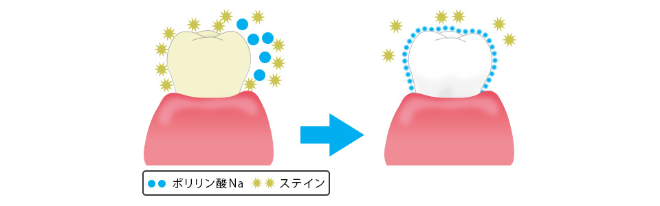 ステインの付着を防ぎ、歯を健康的に美しく